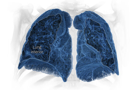 This 3-D reconstruction of lung scans reveals damage that has lingered for years in patients who became severely ill early in the pandemic.